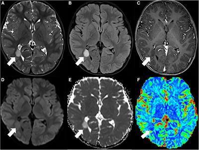 Review on neuroimaging in pediatric-type diffuse low-grade gliomas